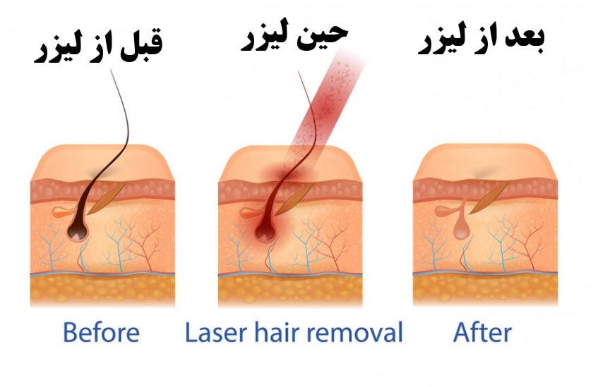 کاربردهای لیزر موهای زائد